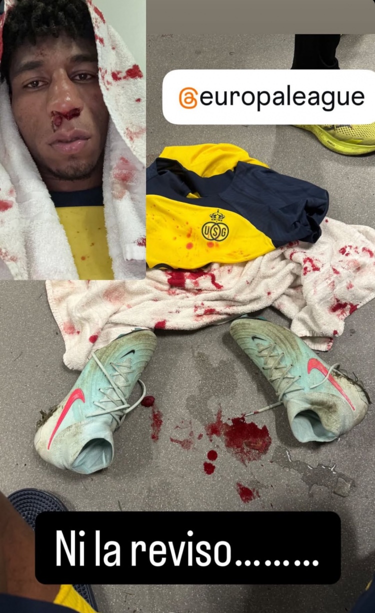  圣吉羅斯前鋒社媒曬鼻子受傷照片，質(zhì)疑裁判漏判點(diǎn)球