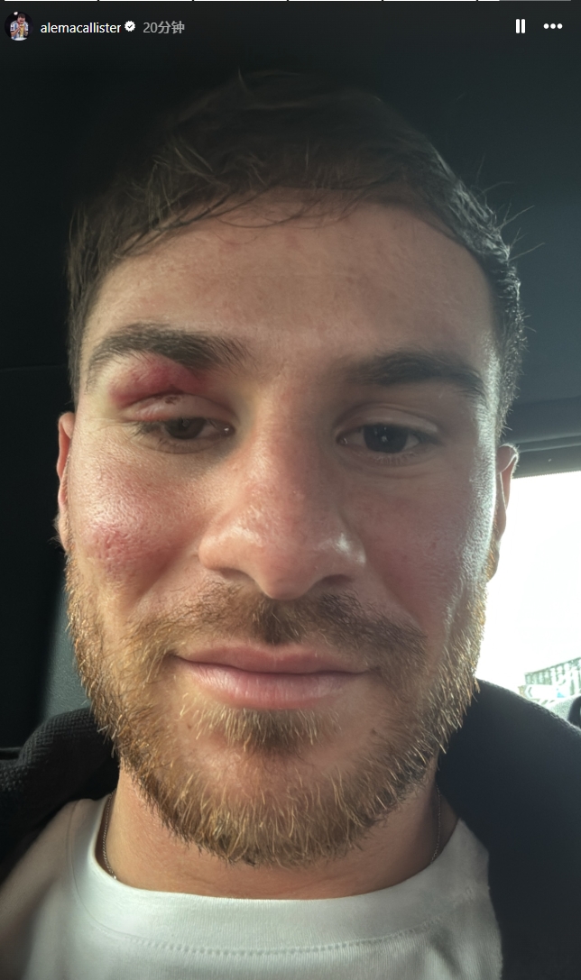  痛并快樂著！麥卡利斯特封堵馬爾穆什射門后“破相”，但心情不錯