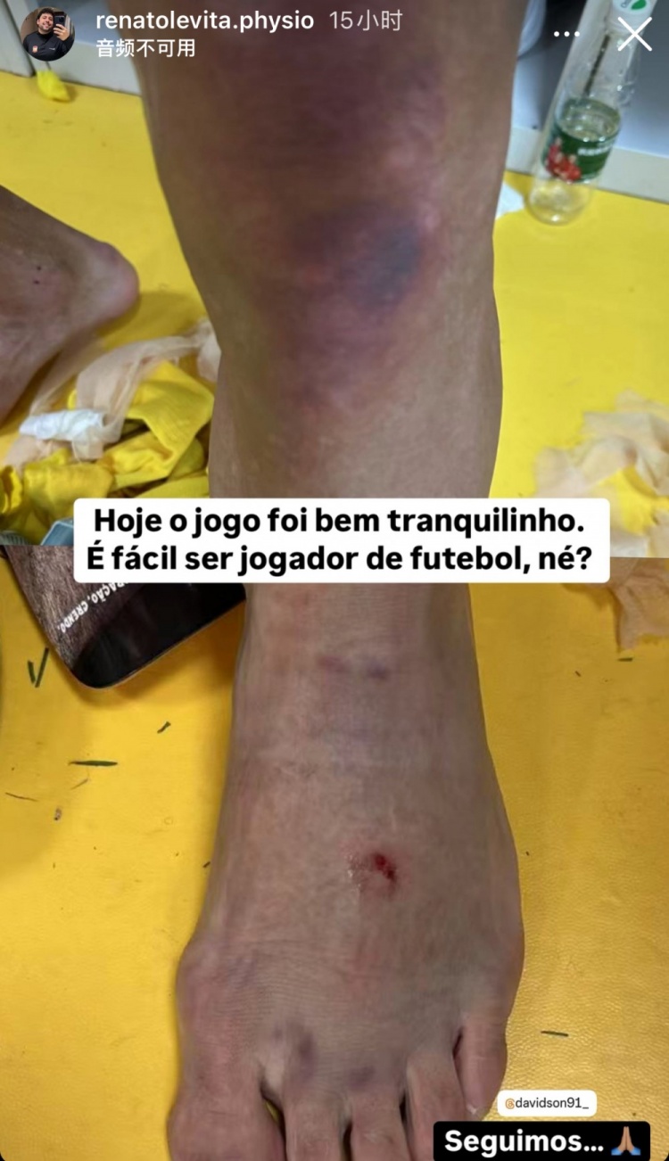  西海岸理療師曬戴維森腿部傷勢照：當(dāng)足球運(yùn)動(dòng)員很容易，對吧？
